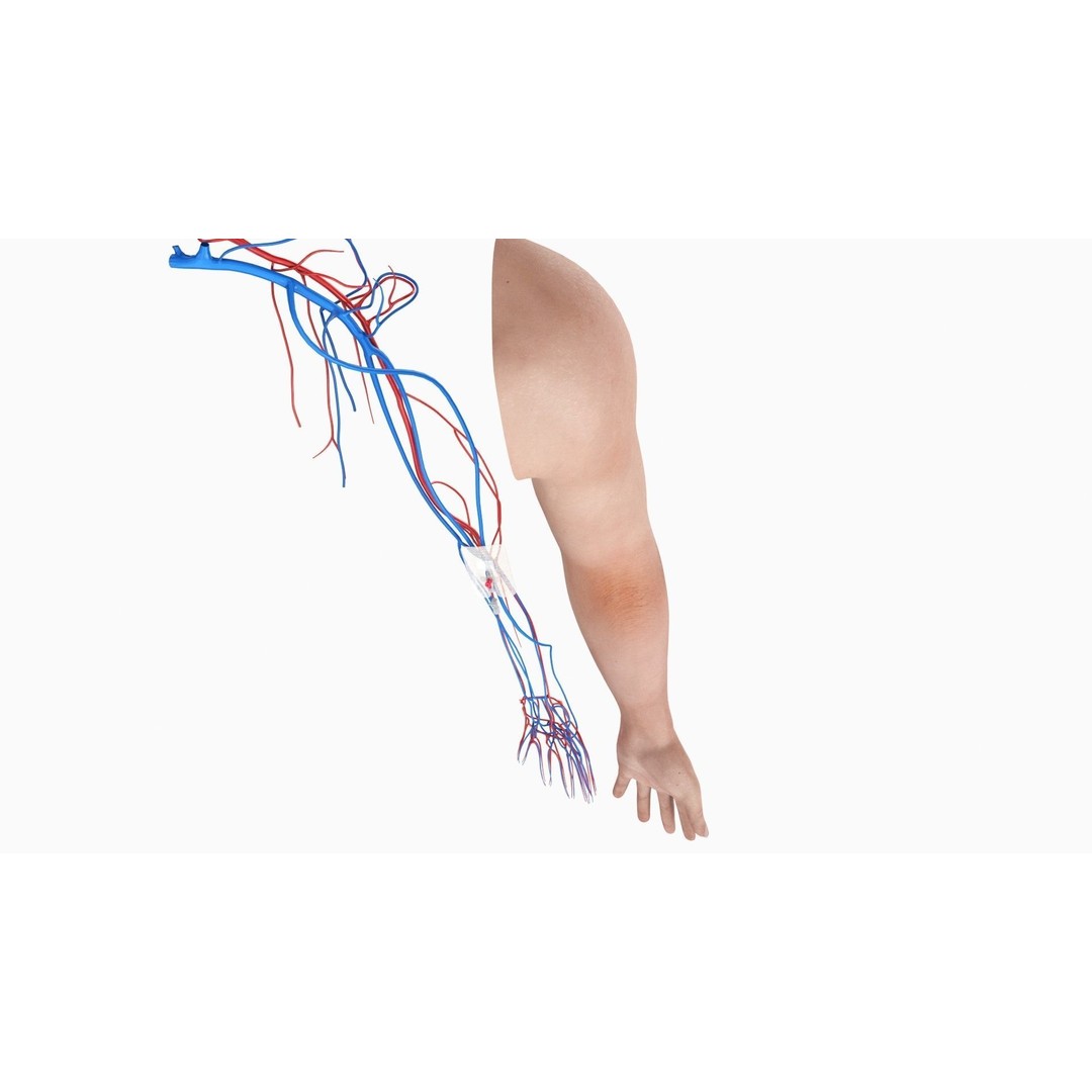 Injected Cannula 3D Model – Low Poly Medical Asset, FBX, Blender - View 10