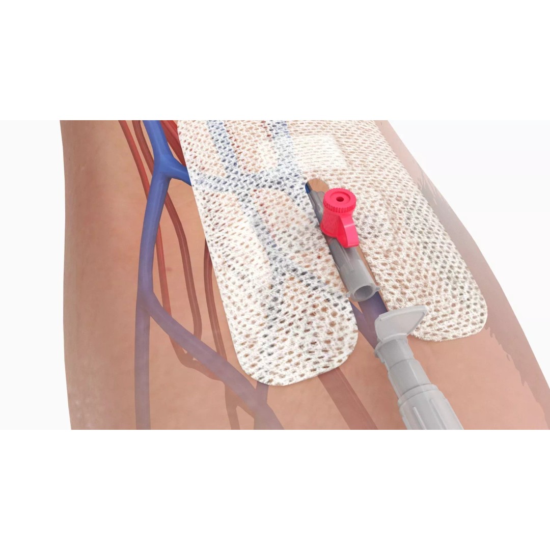 Injected Cannula 3D Model – Low Poly Medical Asset, FBX, Blender - View 2