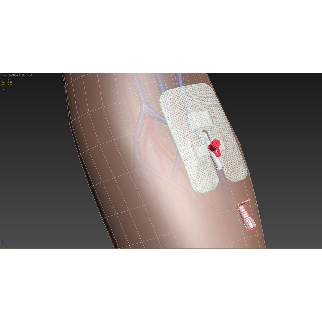 Injected Cannula 3D Model – Low Poly Medical Asset, FBX, Blender - View 21