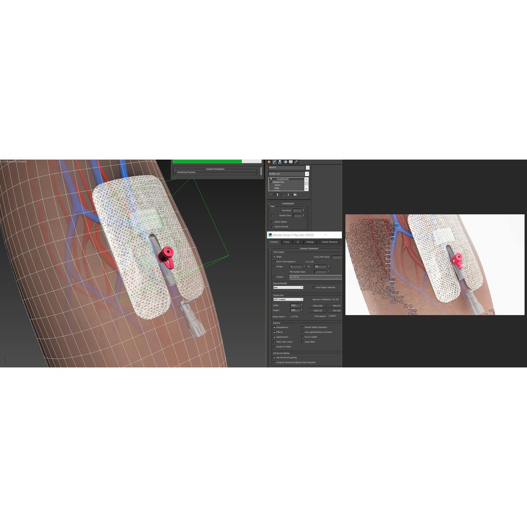 Injected Cannula 3D Model – Low Poly Medical Asset, FBX, Blender - View 22