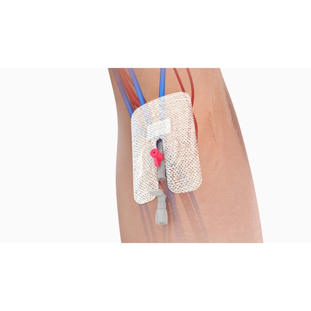 Injected Cannula 3D Model – Low Poly Medical Asset, FBX, Blender - View 3