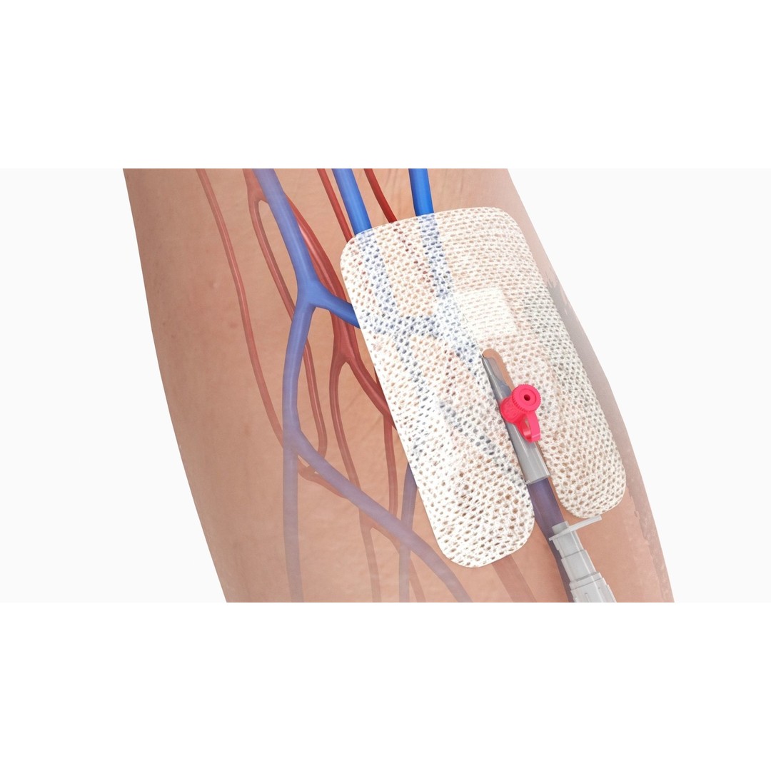 Injected Cannula 3D Model – Low Poly Medical Asset, FBX, Blender - View 4