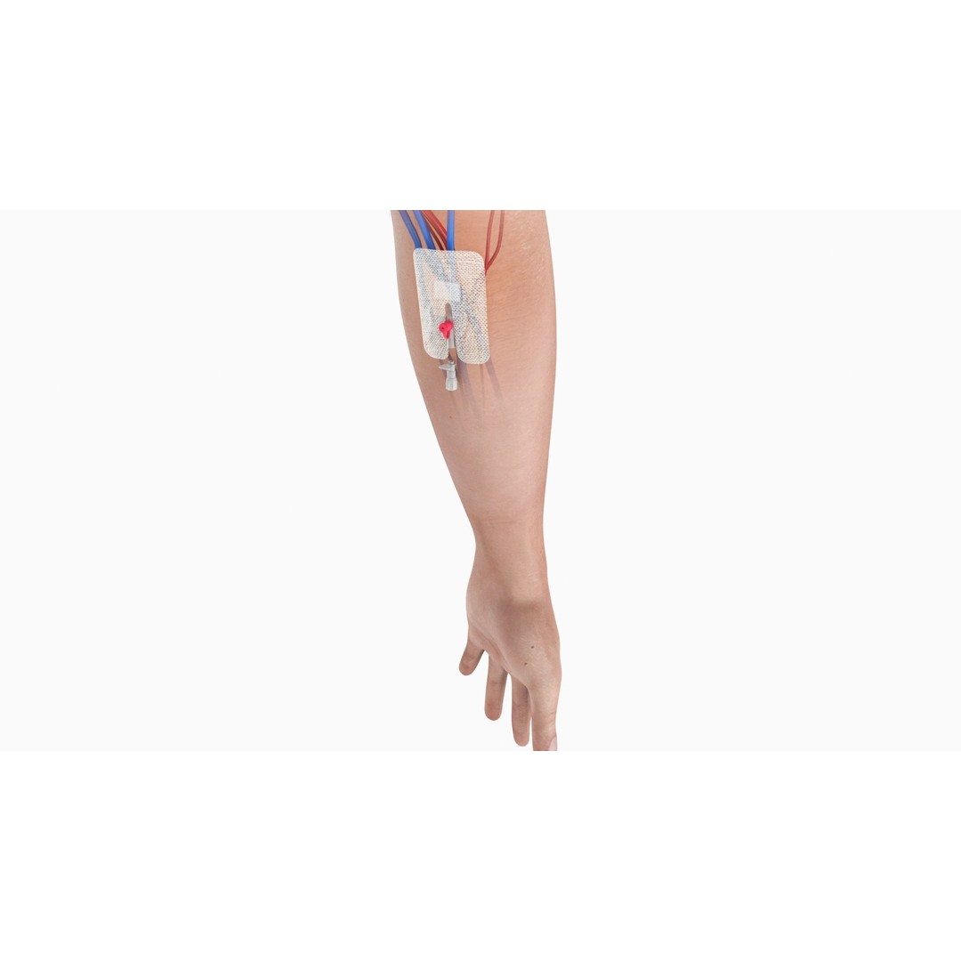 Injected Cannula 3D Model – Low Poly Medical Asset, FBX, Blender - View 7
