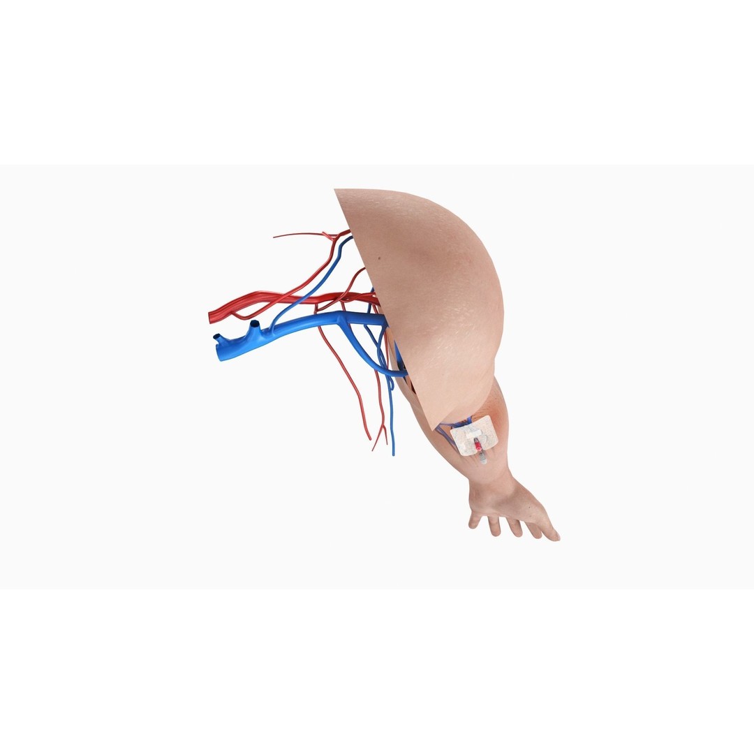 Injected Cannula 3D Model – Low Poly Medical Asset, FBX, Blender - View 9