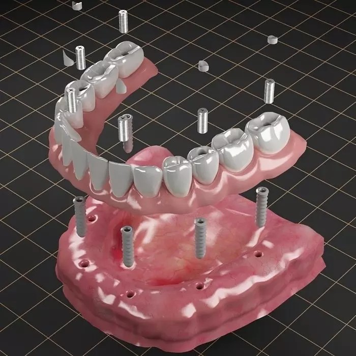 Dental Implant 3D Model – Anatomical Rigged Asset with PBR Textures - View 2