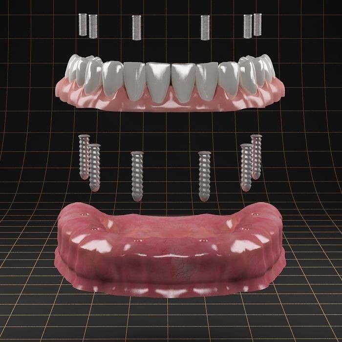 Dental Implant 3D Model – Anatomical Rigged Asset with PBR Textures - View 4