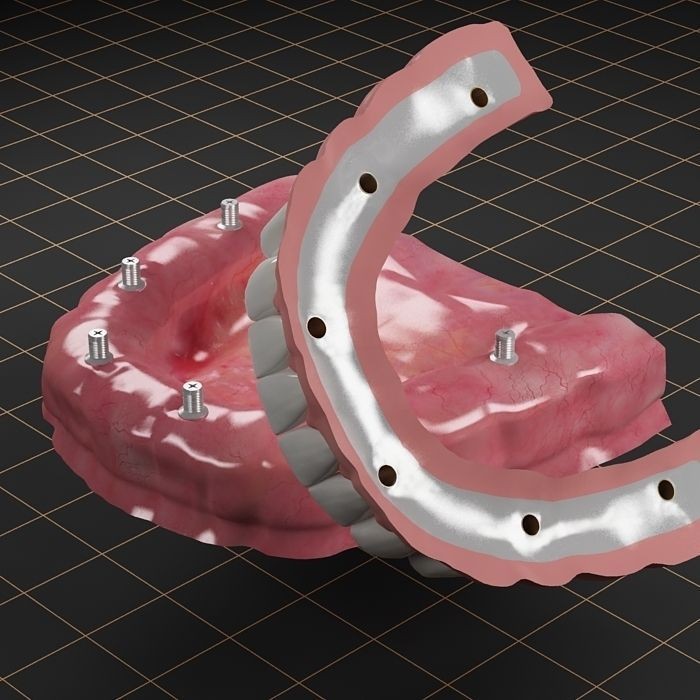 Dental Implant 3D Model – Anatomical Rigged Asset with PBR Textures - View 7