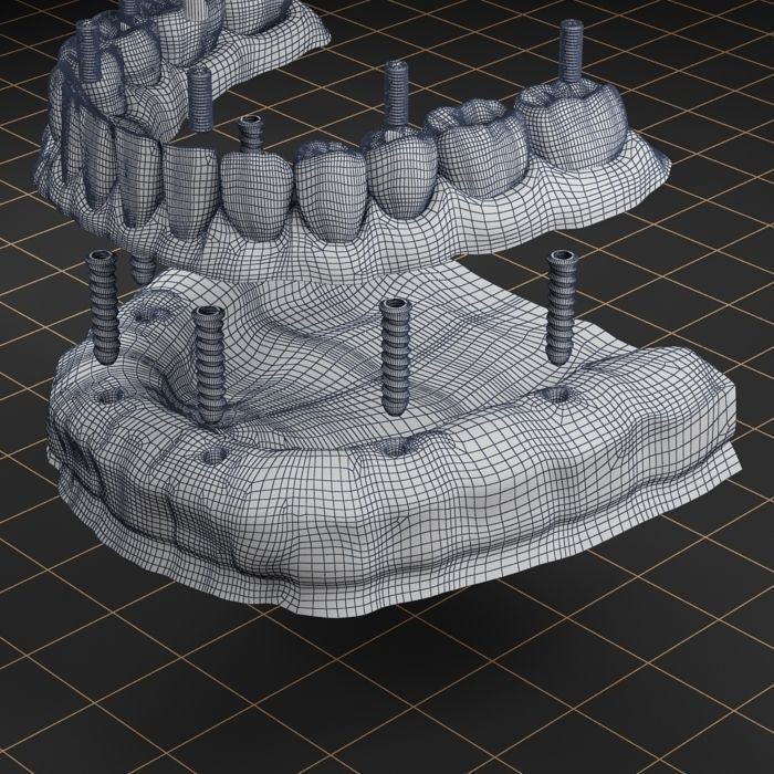 Dental Implant 3D Model – Anatomical Rigged Asset with PBR Textures - View 8