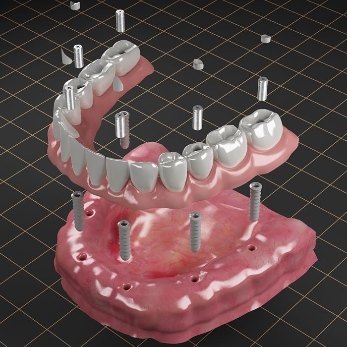 Dental Implant 3D Model – Realistic Anatomy Asset, FBX, OBJ - View 18