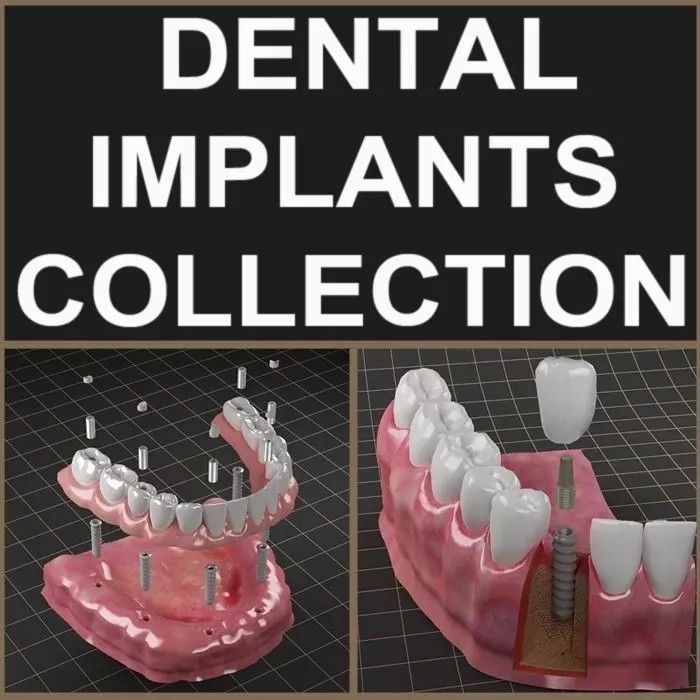 Dental Implant 3D Model – Realistic Anatomy Asset, FBX, OBJ - View 2