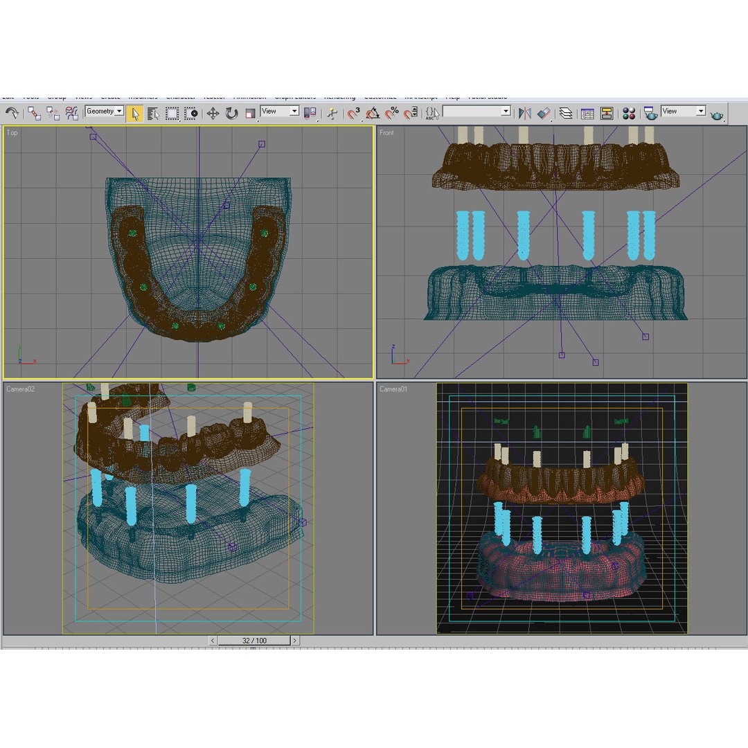 Dental Implant 3D Model – Realistic Anatomy Asset, FBX, OBJ - View 26
