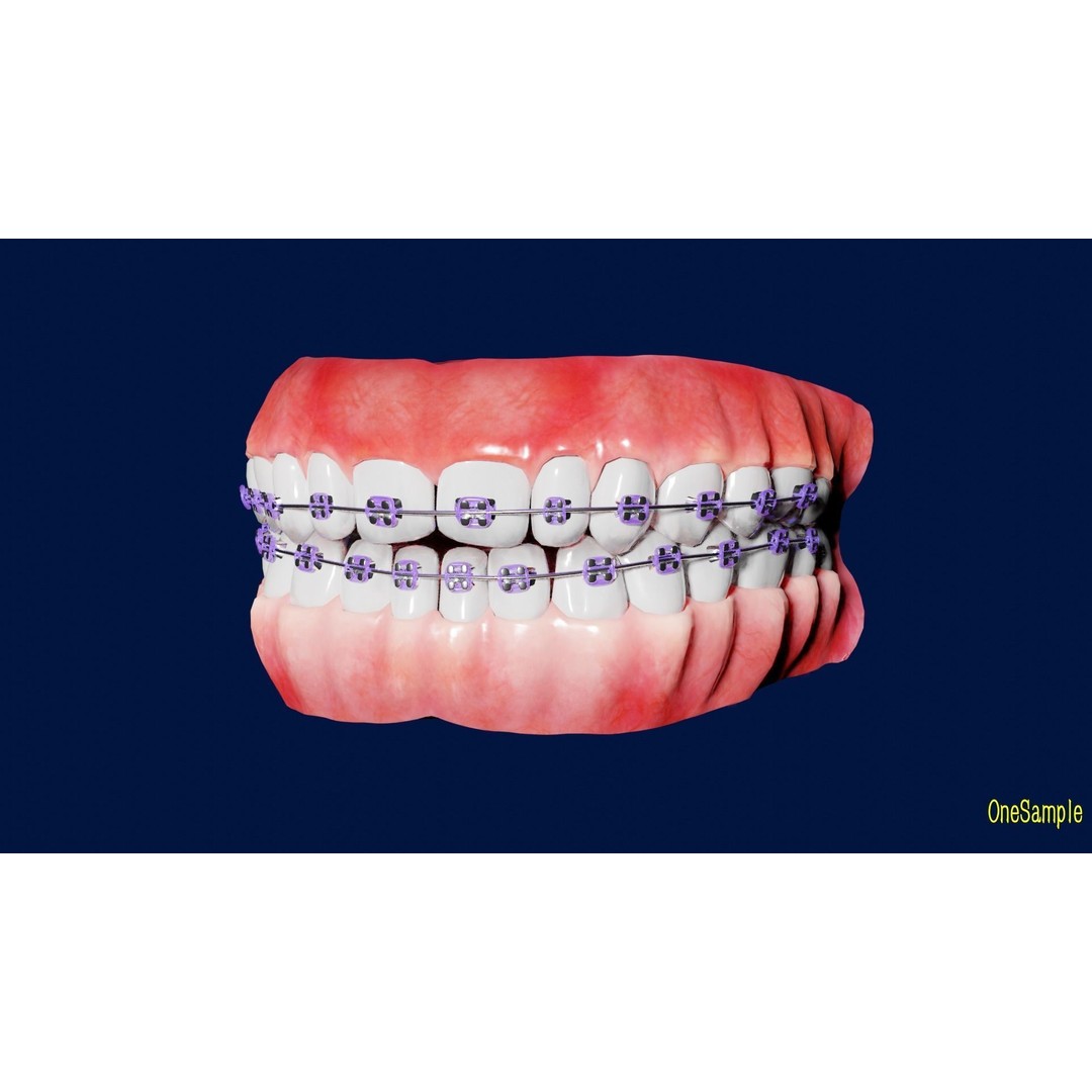Mouth with Braces 3D Model – Low Poly Rigged Character Asset, Blender - View 6