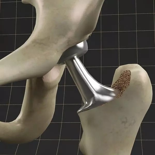 Femoral Prosthesis 3D Model – Realistic Medical Implant, FBX, OBJ - View 2