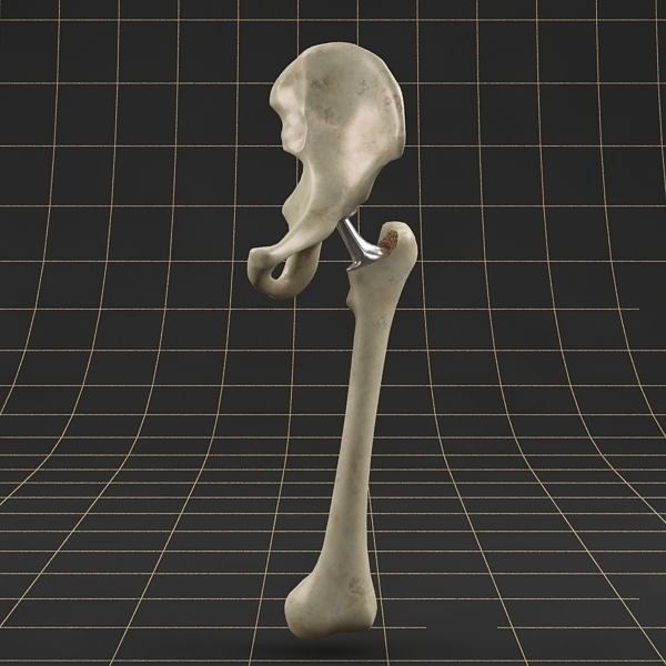 Femoral Prosthesis 3D Model – Realistic Medical Implant, FBX, OBJ - View 3