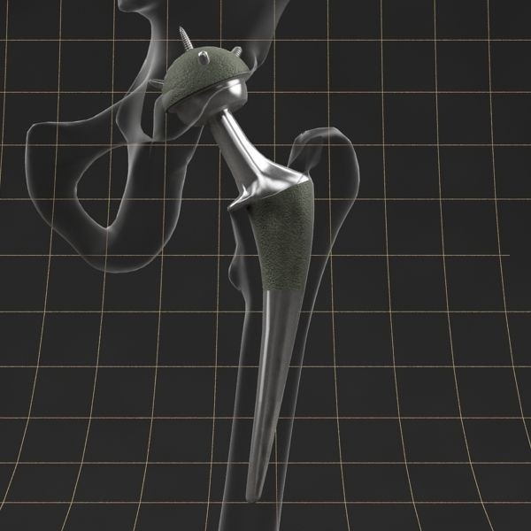 Femoral Prosthesis 3D Model – Realistic Medical Implant, FBX, OBJ - View 4