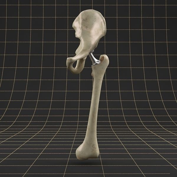 Femoral Prosthesis 3D Model – Realistic Medical Implant, FBX, OBJ - View 6
