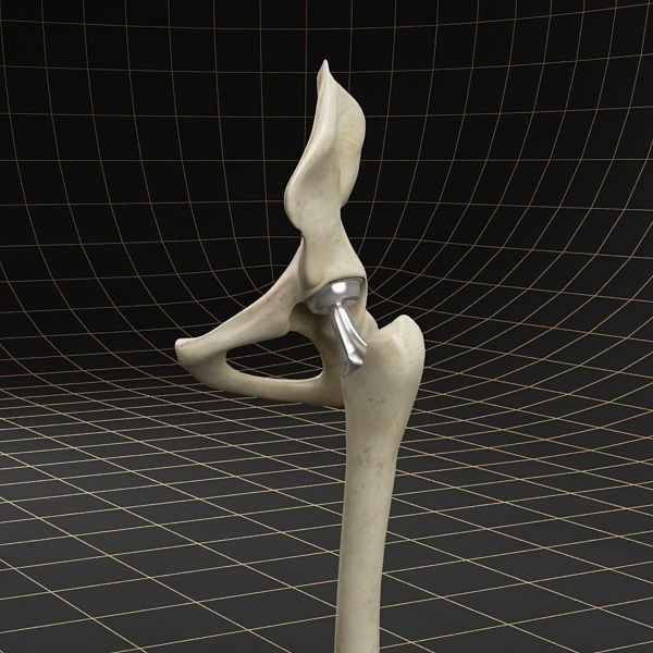 Femoral Prosthesis 3D Model – Realistic Medical Implant, FBX, OBJ - View 7