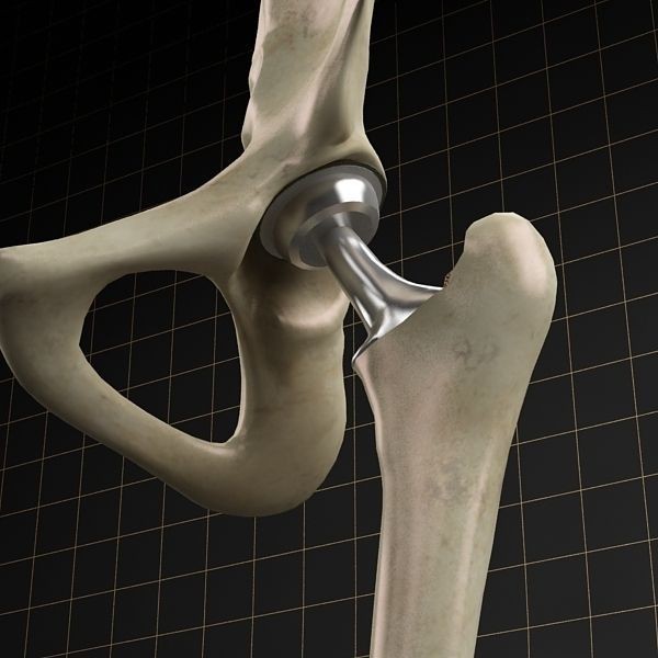 Femoral Prosthesis 3D Model – Realistic Medical Implant, FBX, OBJ - View 8