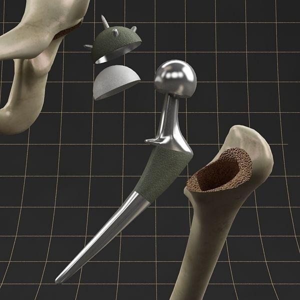 Femoral Prosthesis 3D Model – Realistic Medical Implant, FBX, OBJ - View 9