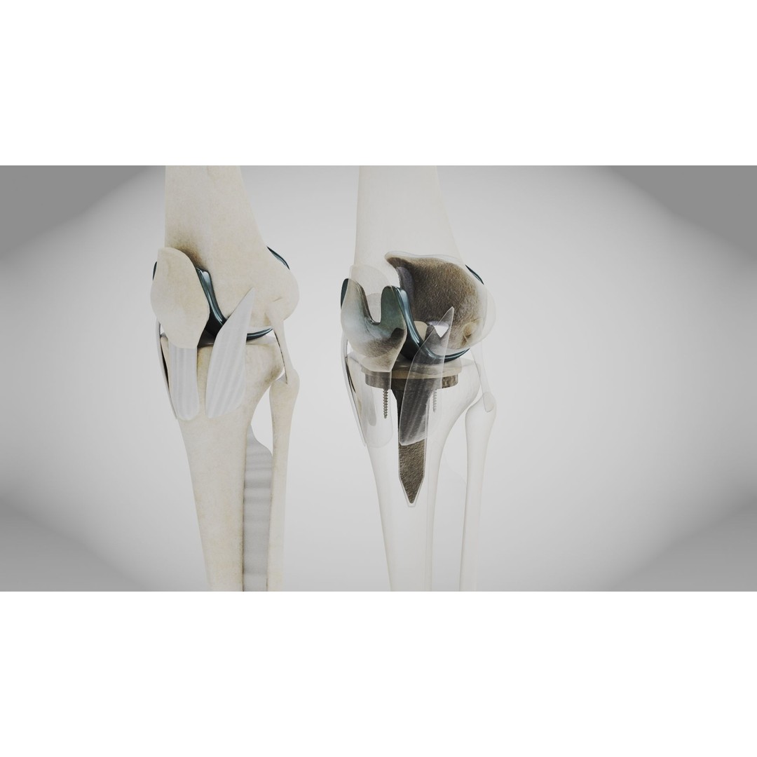 Knee Implant 3D Model – Low Poly Medical Asset, PBR Textures - View 11