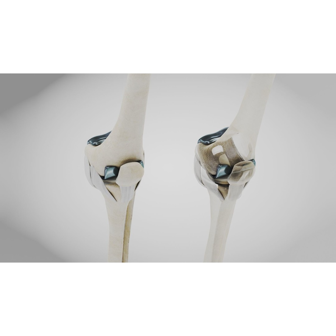 Knee Implant 3D Model – Low Poly Medical Asset, PBR Textures - View 12