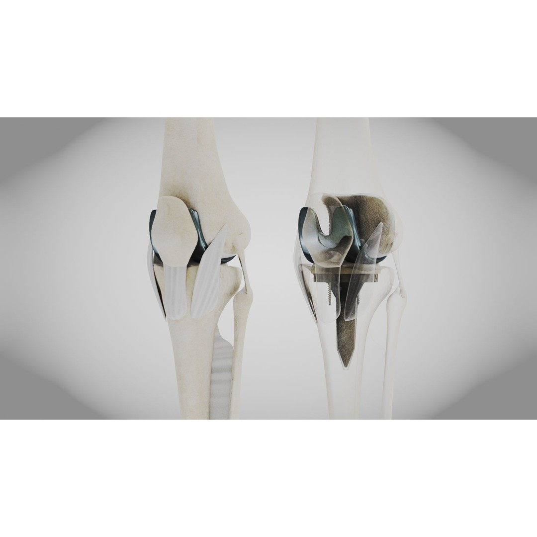 Knee Implant 3D Model – Low Poly Medical Asset, PBR Textures - View 13