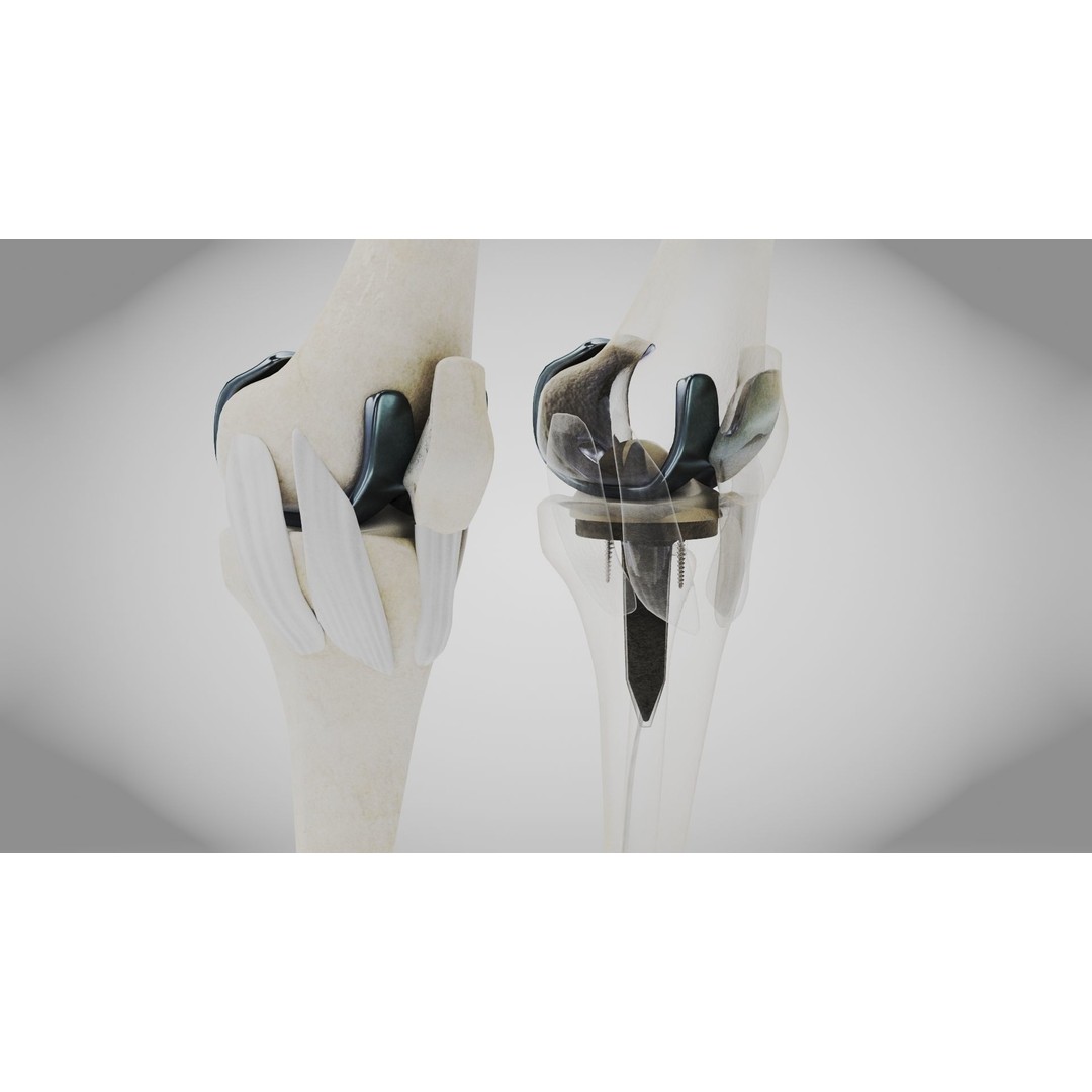Knee Implant 3D Model – Low Poly Medical Asset, PBR Textures - View 3
