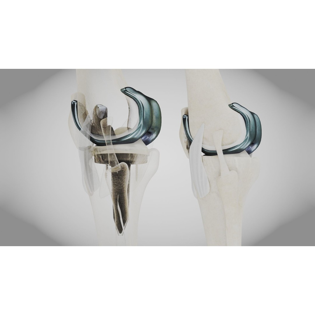 Knee Implant 3D Model – Low Poly Medical Asset, PBR Textures - View 4