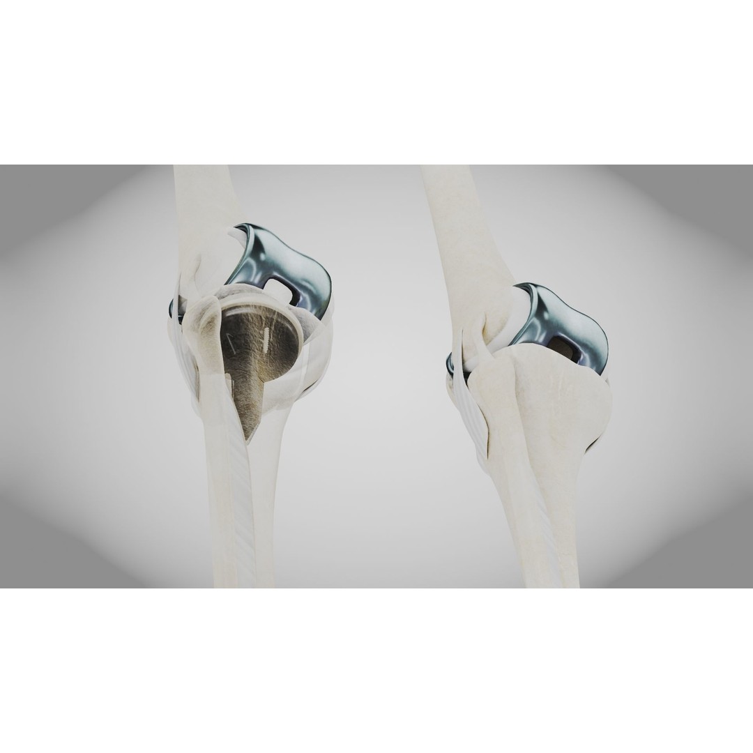 Knee Implant 3D Model – Low Poly Medical Asset, PBR Textures - View 5