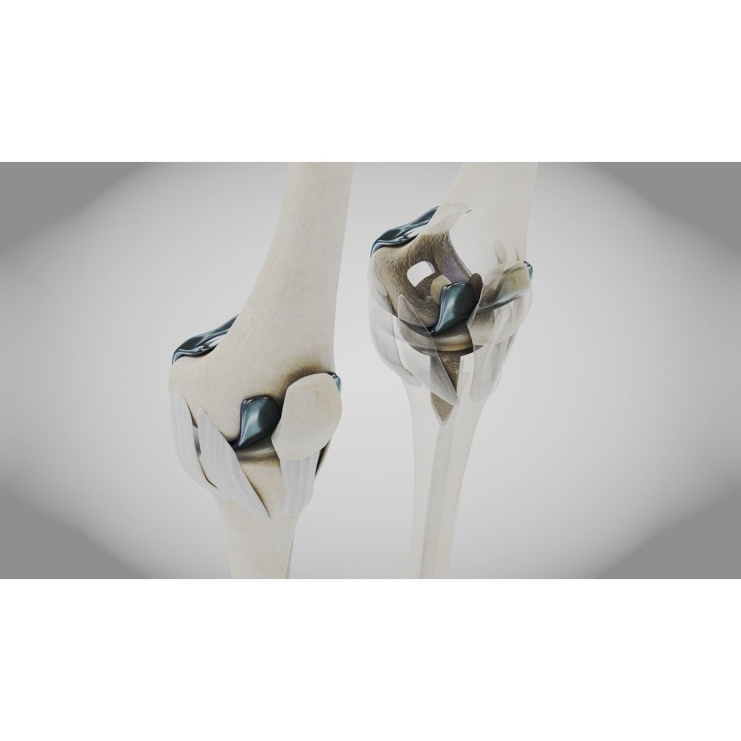 Knee Implant 3D Model – Low Poly Medical Asset, PBR Textures - View 7