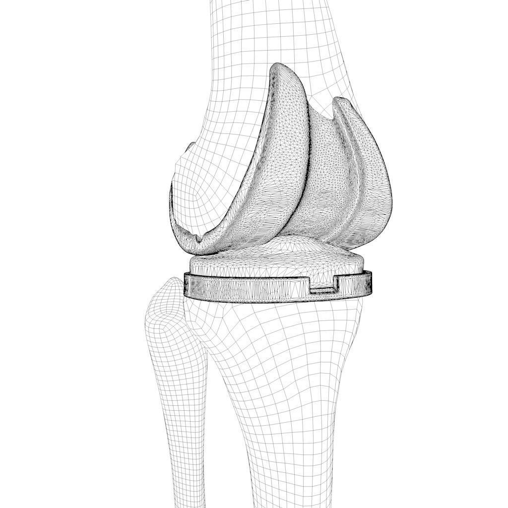 Knee Replacement Implant 3D Model – High Poly PBR Asset, FBX & OBJ Formats - View 10