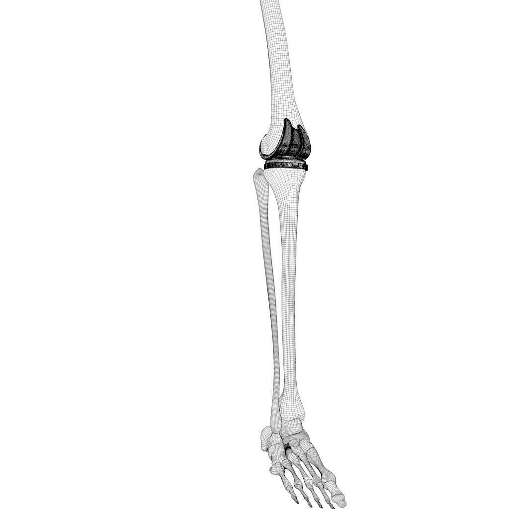Knee Replacement Implant 3D Model – High Poly PBR Asset, FBX & OBJ Formats - View 11