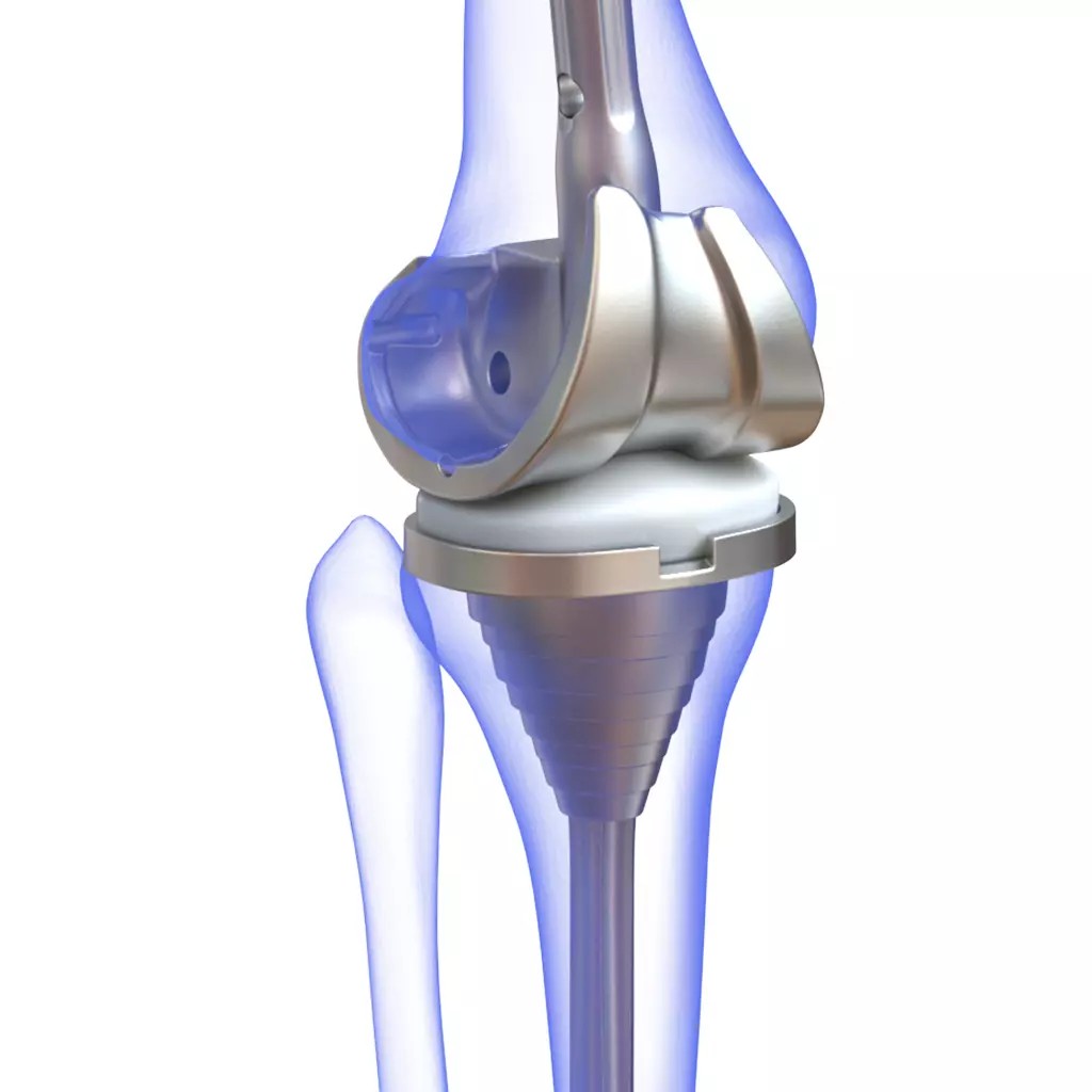 Knee Replacement Implant 3D Model – High Poly PBR Asset, FBX & OBJ Formats - View 2