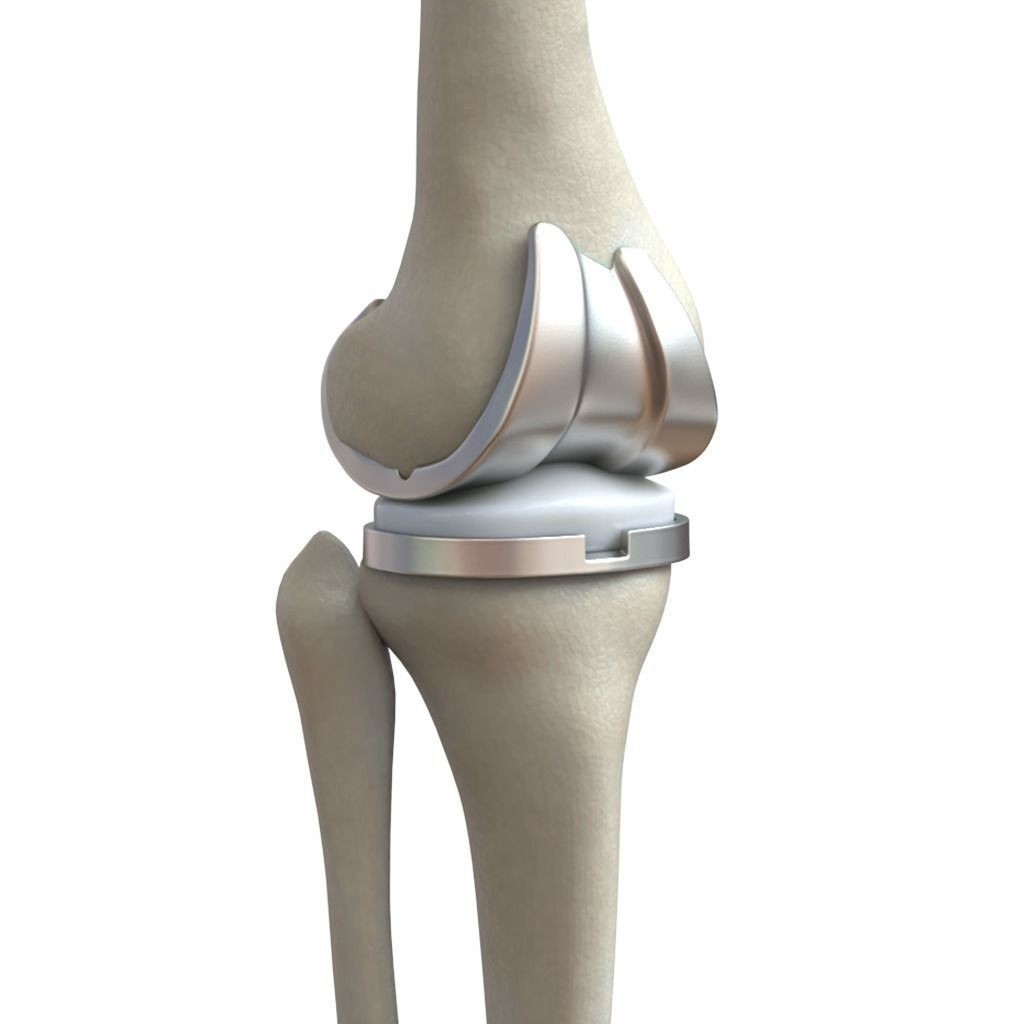 Knee Replacement Implant 3D Model – High Poly PBR Asset, FBX & OBJ Formats - View 3