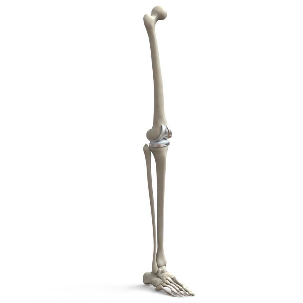 Knee Replacement Implant 3D Model – High Poly PBR Asset, FBX & OBJ Formats - View 5