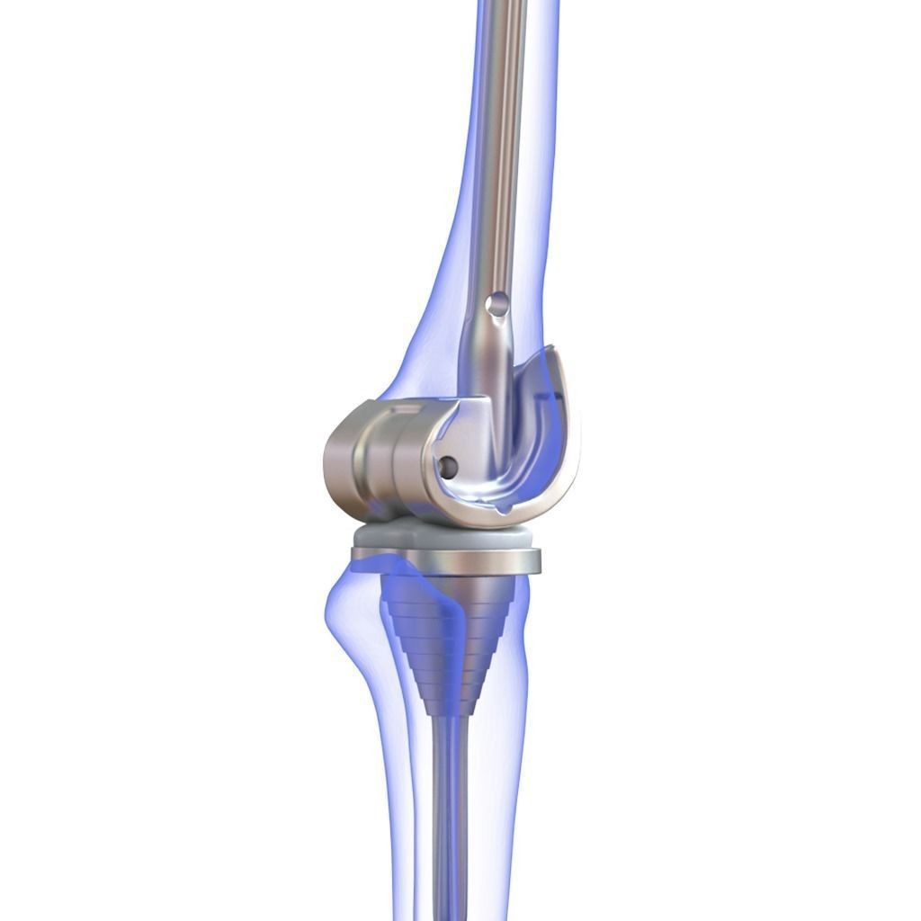 Knee Replacement Implant 3D Model – High Poly PBR Asset, FBX & OBJ Formats - View 7