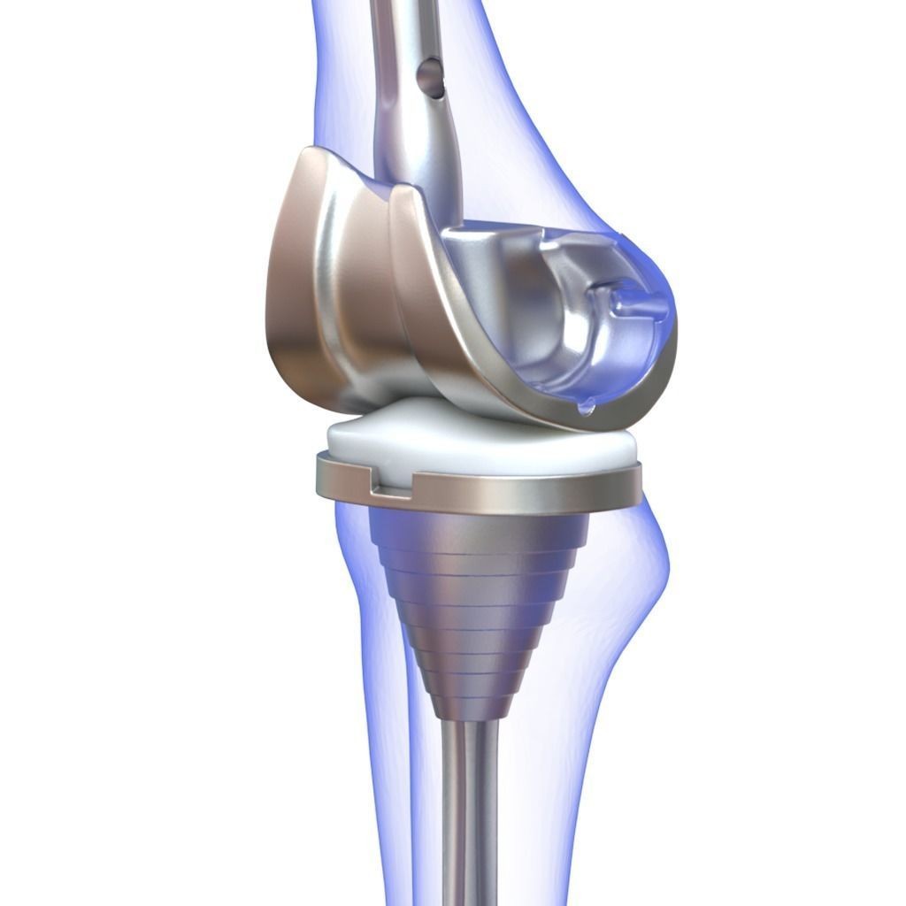 Knee Replacement Implant 3D Model – High Poly PBR Asset, FBX & OBJ Formats - View 9