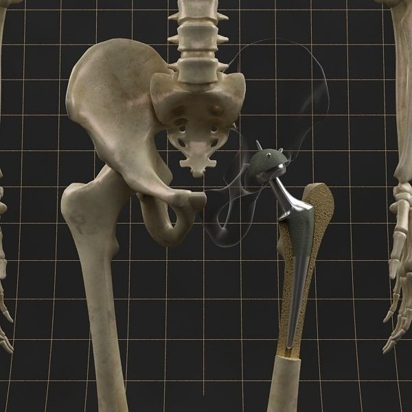 Femoral Prosthesis 3D Model – Anatomical Skeleton with PBR Textures, FBX - View 10