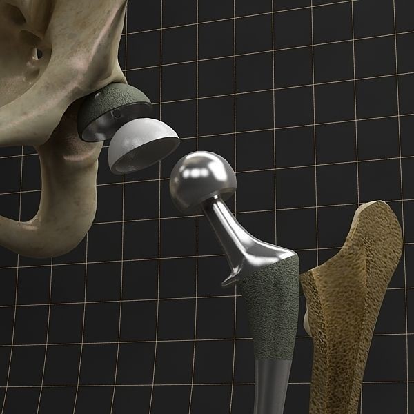 Femoral Prosthesis 3D Model – Anatomical Skeleton with PBR Textures, FBX - View 11
