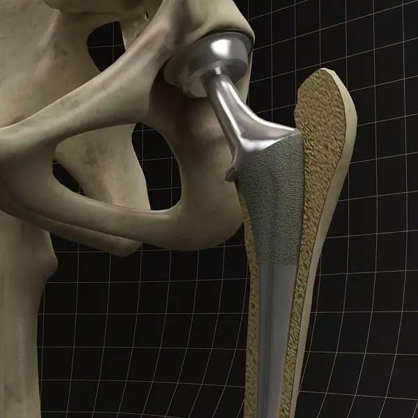Femoral Prosthesis 3D Model – Anatomical Skeleton with PBR Textures, FBX - View 2