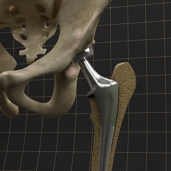 Femoral Prosthesis 3D Model – Anatomical Skeleton with PBR Textures, FBX - View 3