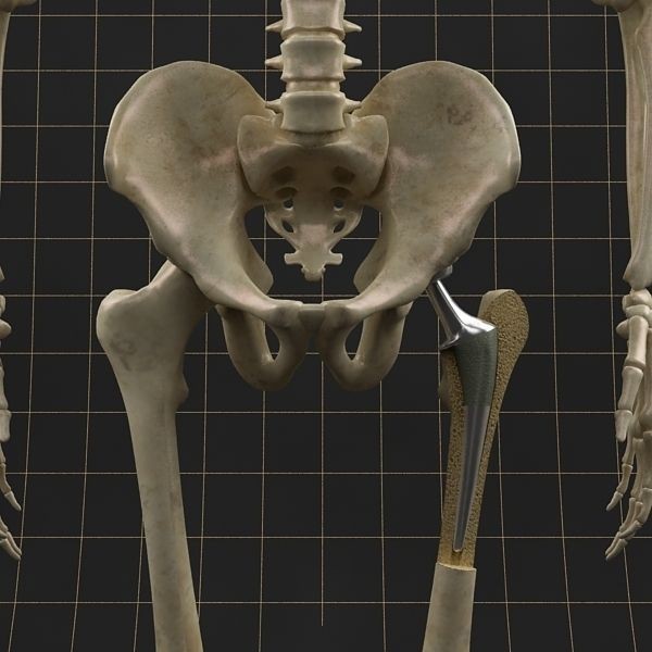 Femoral Prosthesis 3D Model – Anatomical Skeleton with PBR Textures, FBX - View 5
