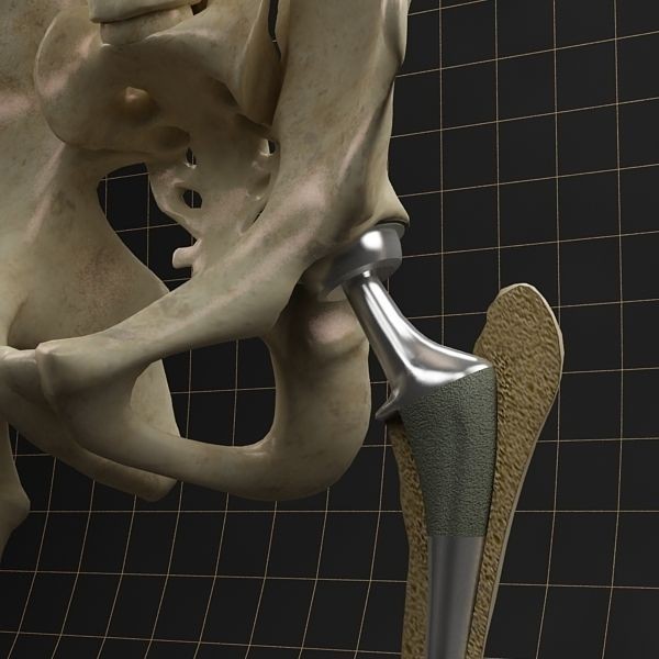 Femoral Prosthesis 3D Model – Anatomical Skeleton with PBR Textures, FBX - View 6