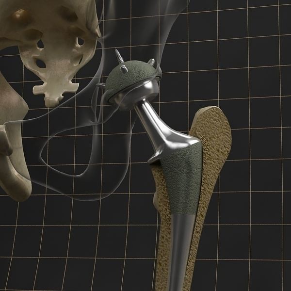 Femoral Prosthesis 3D Model – Anatomical Skeleton with PBR Textures, FBX - View 9