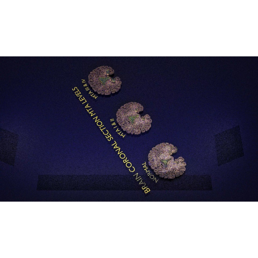 Hippocampus 3D Model – Low Poly MTA Atrophy Levels for Medical Use