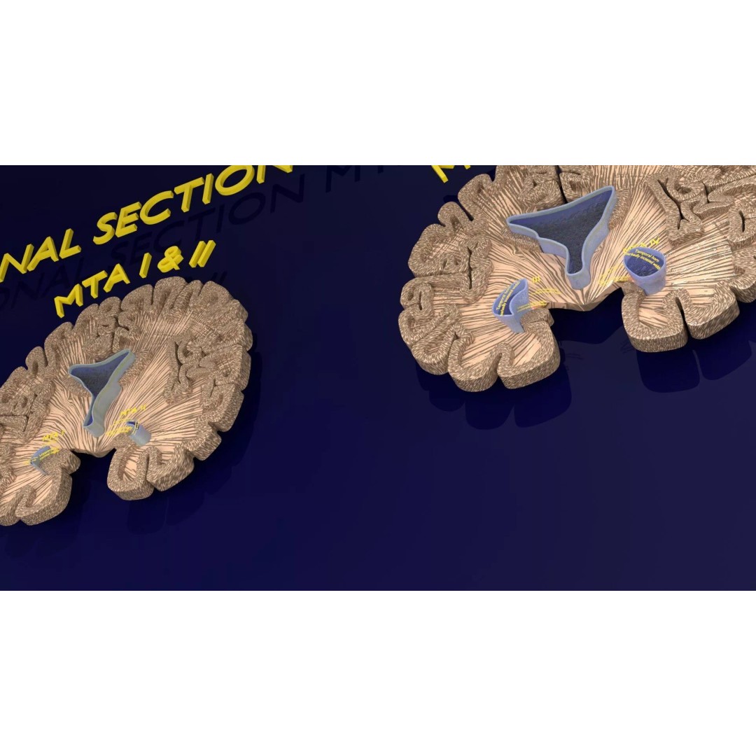 Hippocampus 3D Model – Low Poly MTA Atrophy Levels for Medical Use - View 10