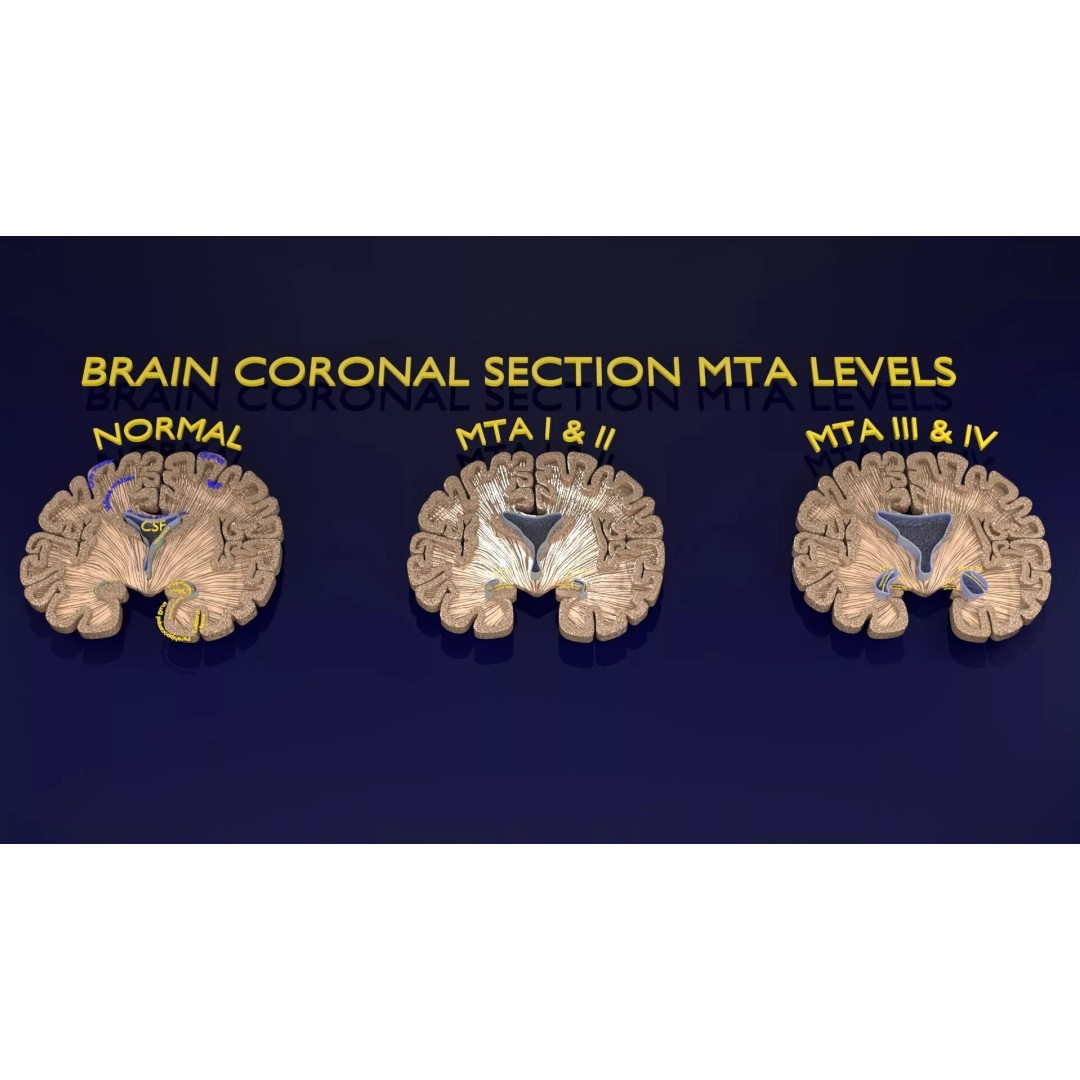 Hippocampus 3D Model – Low Poly MTA Atrophy Levels for Medical Use - View 11