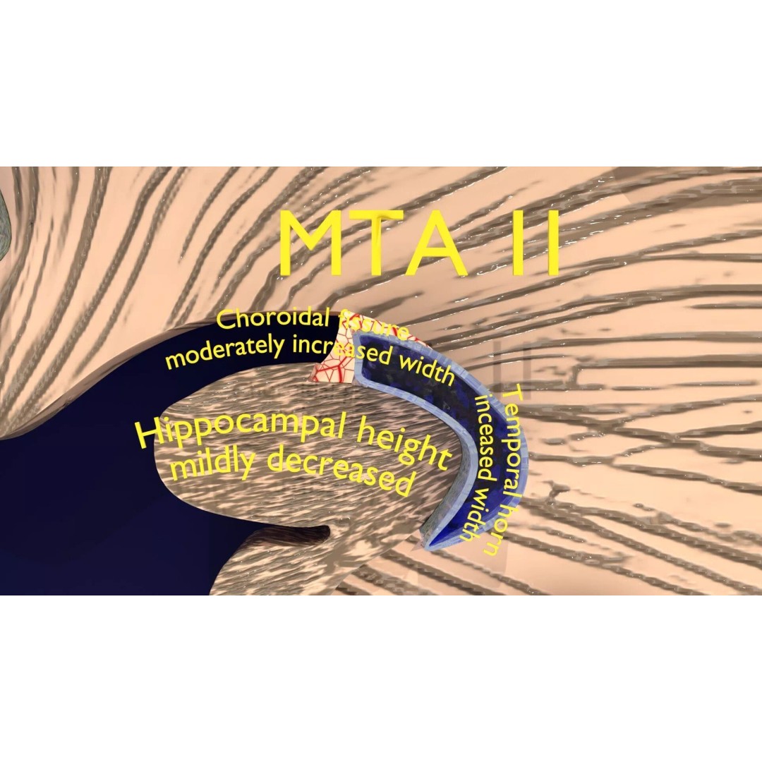 Hippocampus 3D Model – Low Poly MTA Atrophy Levels for Medical Use - View 12