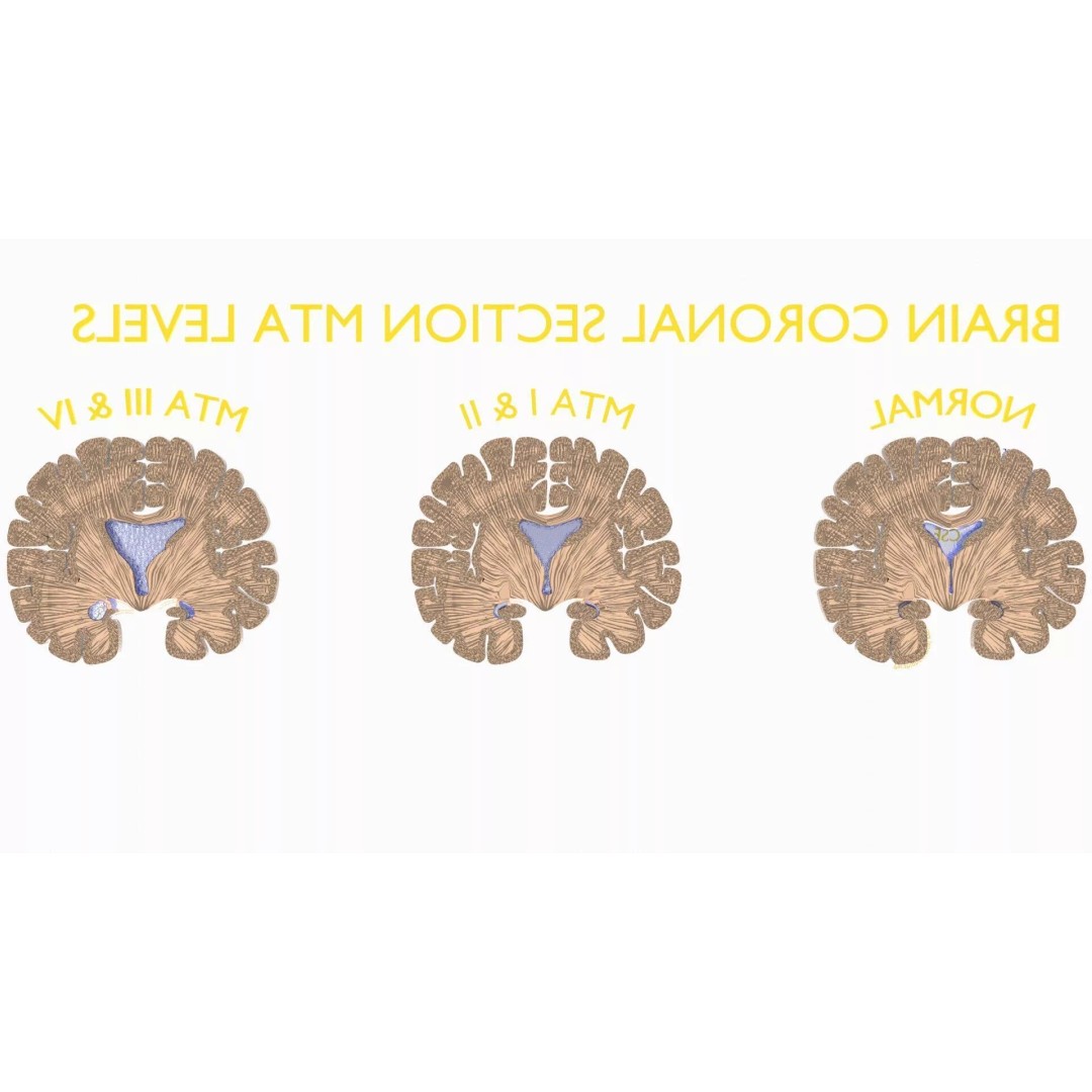 Hippocampus 3D Model – Low Poly MTA Atrophy Levels for Medical Use - View 13