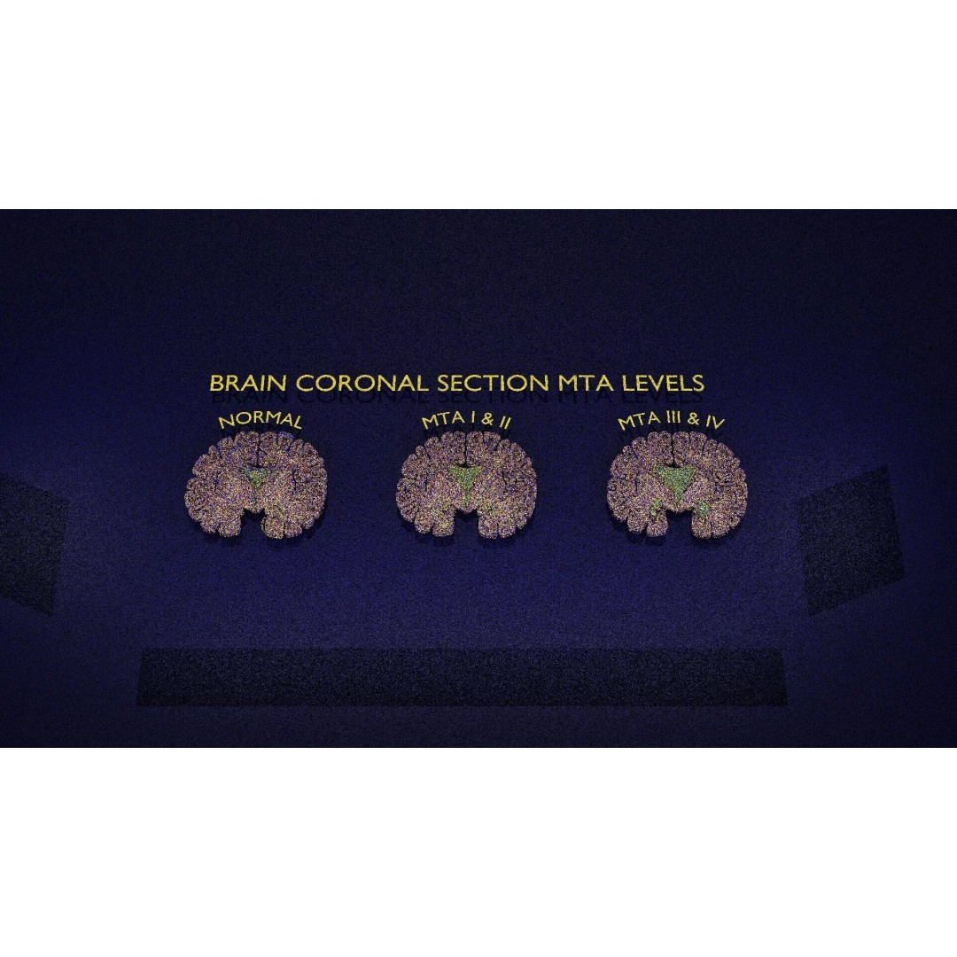 Hippocampus 3D Model – Low Poly MTA Atrophy Levels for Medical Use - View 14